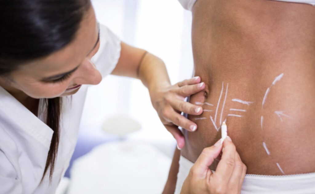 ¿Cuánto cuesta la lipoescultura en Estados Unidos?